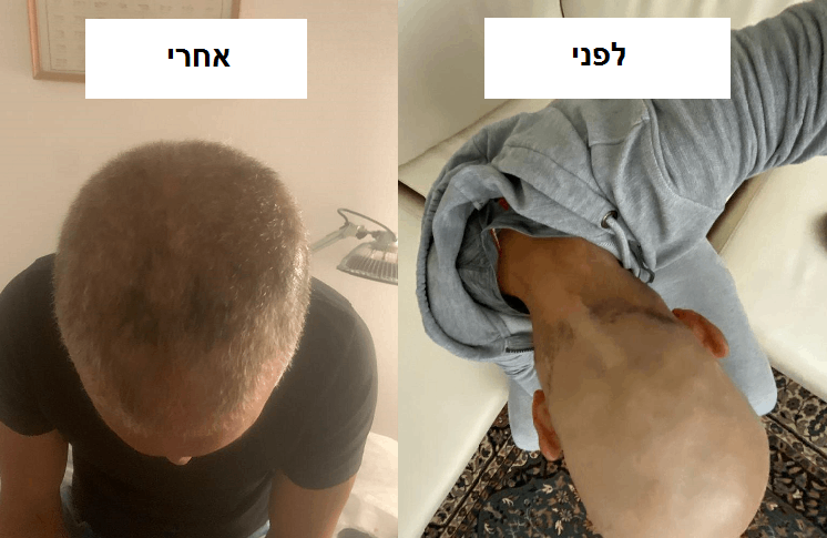 אלופציה – יומן החלמה ח.